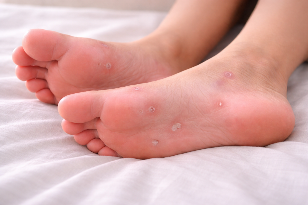 सिफलिस (Syphilis) क्या है और इसके लक्षण